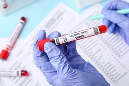 Paran� chega a 19 casos de monkeypox; Brasil tem 813